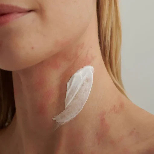 EXTRODERM Intensivcreme